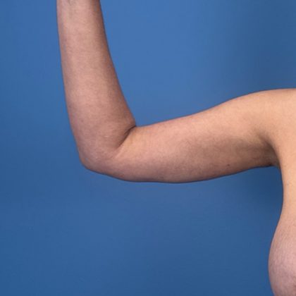 Arm Lift Before & After Patient #3150
