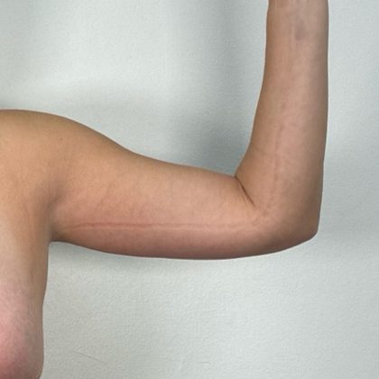 Arm Lift Before & After Patient #3151