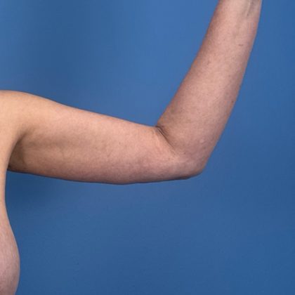 Arm Lift Before & After Patient #3150