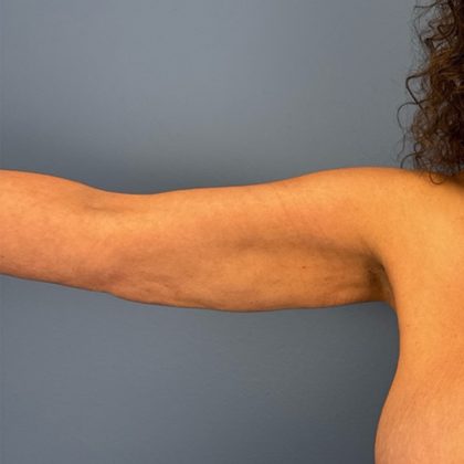 Arm Lift Before & After Patient #3150