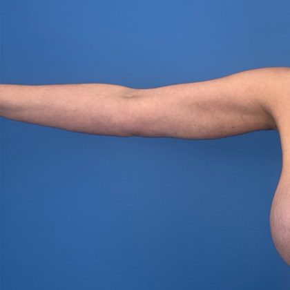 Arm Lift Before & After Patient #3150