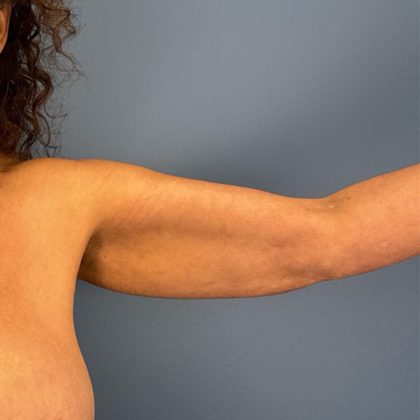 Arm Lift Before & After Patient #3150