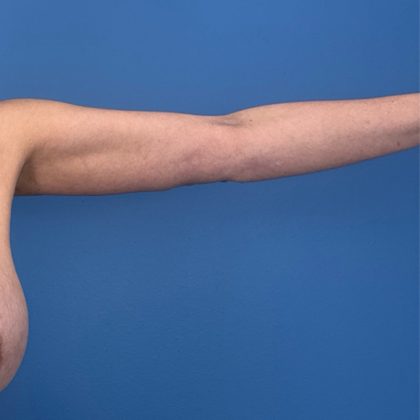 Arm Lift Before & After Patient #3150