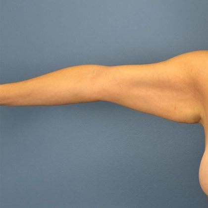Arm Lift Before & After Patient #3150