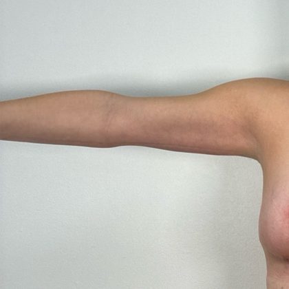 Arm Lift Before & After Patient #3150