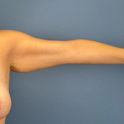 Arm Lift Before & After Patient #3150