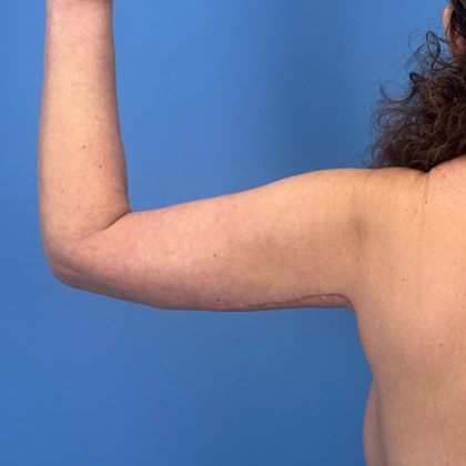 Arm Lift Before & After Patient #3150