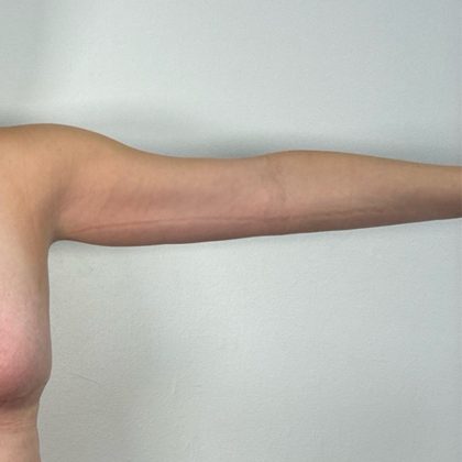 Arm Lift Before & After Patient #3150