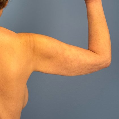 Arm Lift Before & After Patient #3150