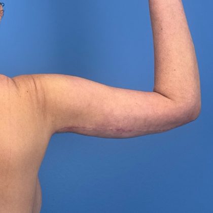 Arm Lift Before & After Patient #3150