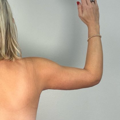 Arm Lift Before & After Patient #3151