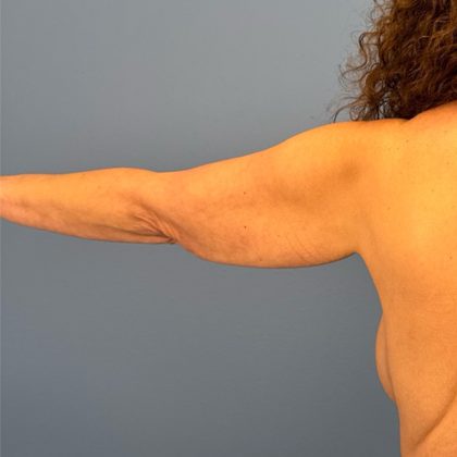 Arm Lift Before & After Patient #3150