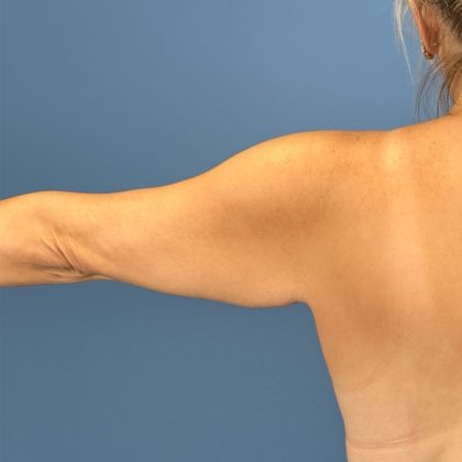 Arm Lift Before & After Patient #3151