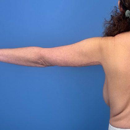 Arm Lift Before & After Patient #3150