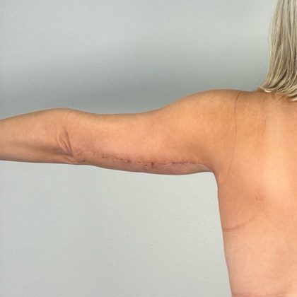 Arm Lift Before & After Patient #3151