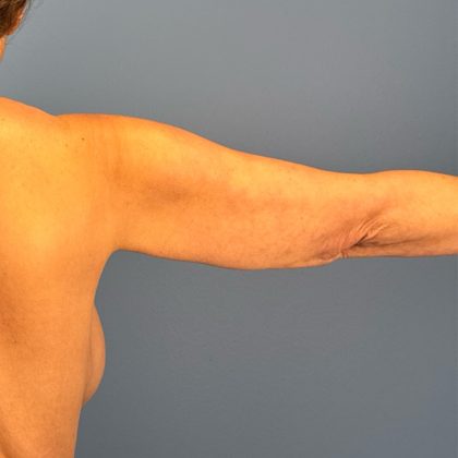 Arm Lift Before & After Patient #3150