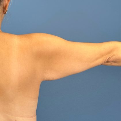 Arm Lift Before & After Patient #3151