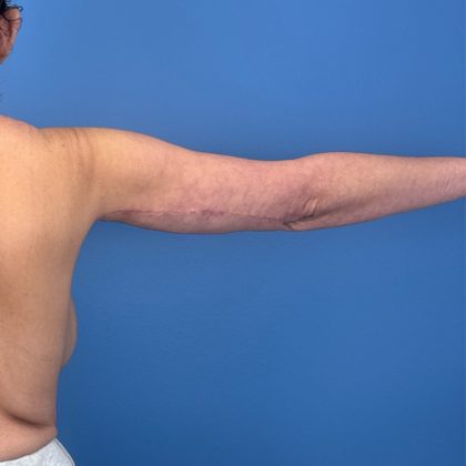 Arm Lift Before & After Patient #3150