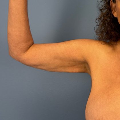 Arm Lift Before & After Patient #3150