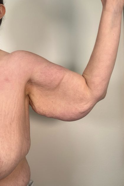 Arm Lift Before & After Patient #3277