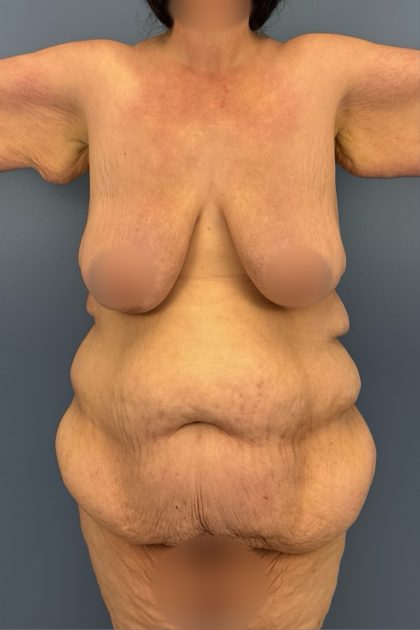 Lower Body Lift Before & After Patient #3276