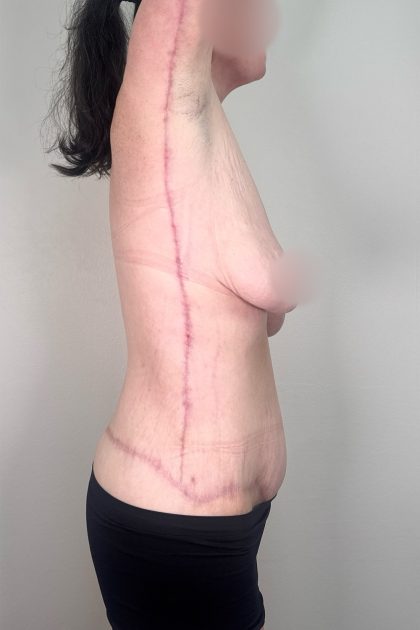 Arm Lift Before & After Patient #3277