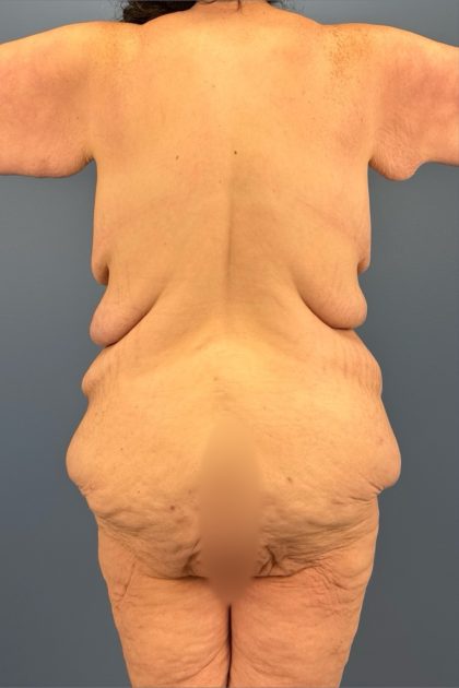 Lower Body Lift Before & After Patient #3276