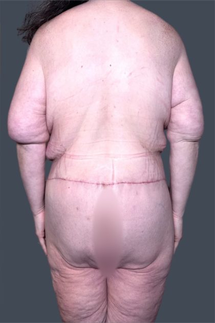Lower Body Lift Before & After Patient #3276