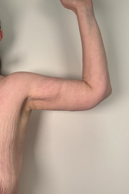 Arm Lift Before & After Patient #3277