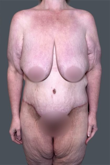 Lower Body Lift Before & After Patient #3276