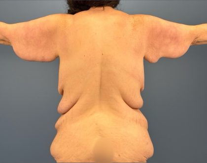Arm Lift Before & After Patient #3277