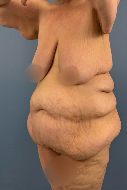 Lower Body Lift Before & After Patient #3276