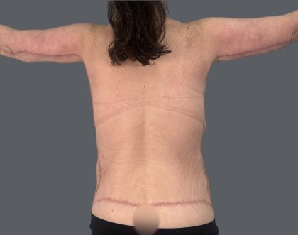 Arm Lift Before & After Patient #3277