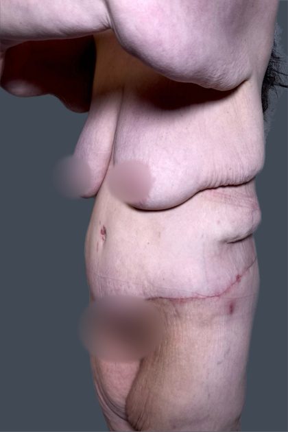 Lower Body Lift Before & After Patient #3276