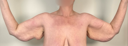 Arm Lift Before & After Patient #3277