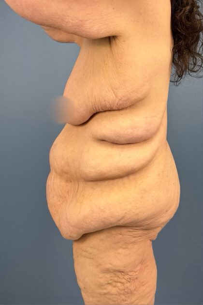 Lower Body Lift Before & After Patient #3276