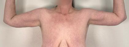 Arm Lift Before & After Patient #3277