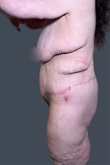 Lower Body Lift Before & After Patient #3276