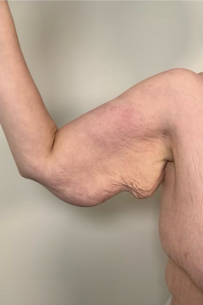 Arm Lift Before & After Patient #3277