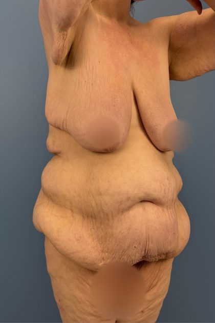 Lower Body Lift Before & After Patient #3276