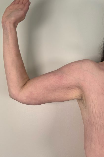 Arm Lift Before & After Patient #3277