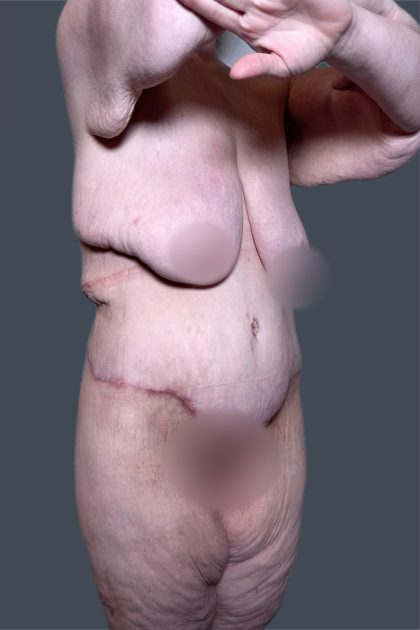 Lower Body Lift Before & After Patient #3276