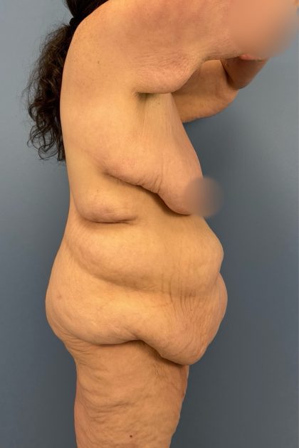 Arm Lift Before & After Patient #3277