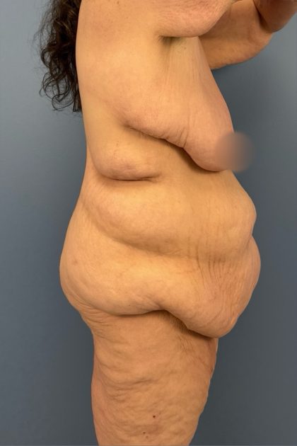 Lower Body Lift Before & After Patient #3276