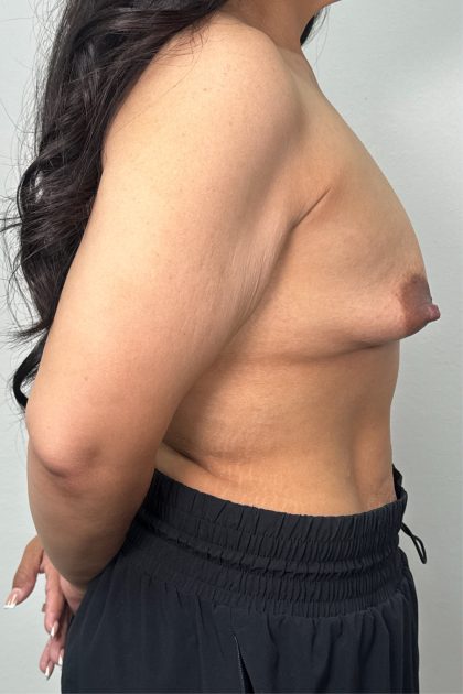 Breast Lift Before & After Patient #3245