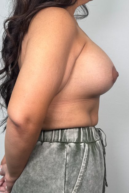 Breast Lift Before & After Patient #3245