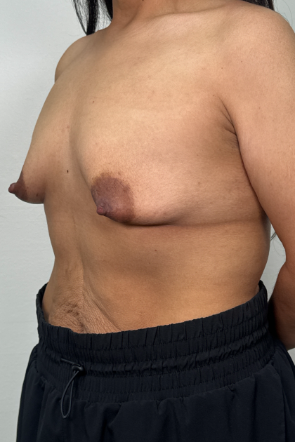 Breast Lift Before & After Patient #3245