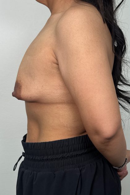 Breast Lift Before & After Patient #3245