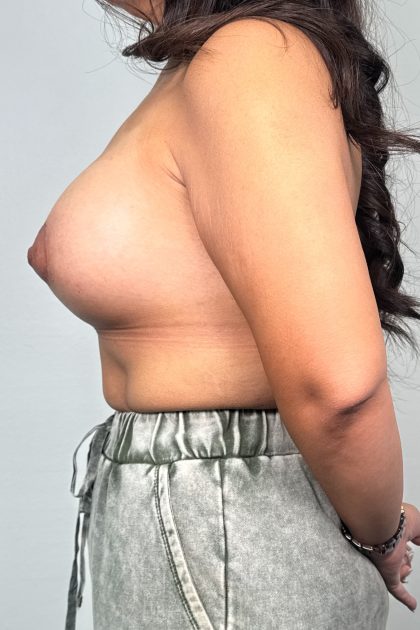 Breast Lift Before & After Patient #3245